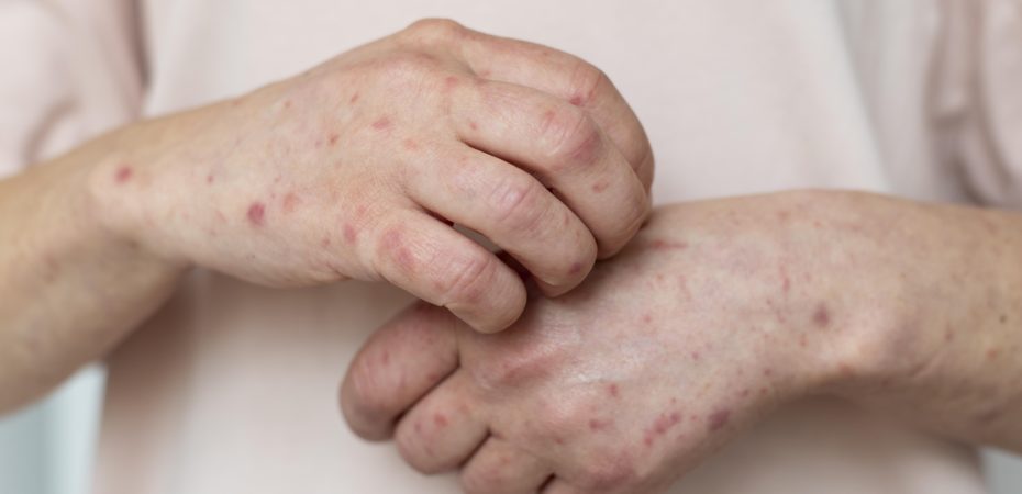 Varicella agrega más de 2200 casos a Costa Rica este año: los adultos jóvenes concentran más contagios

 – Noticias cr
